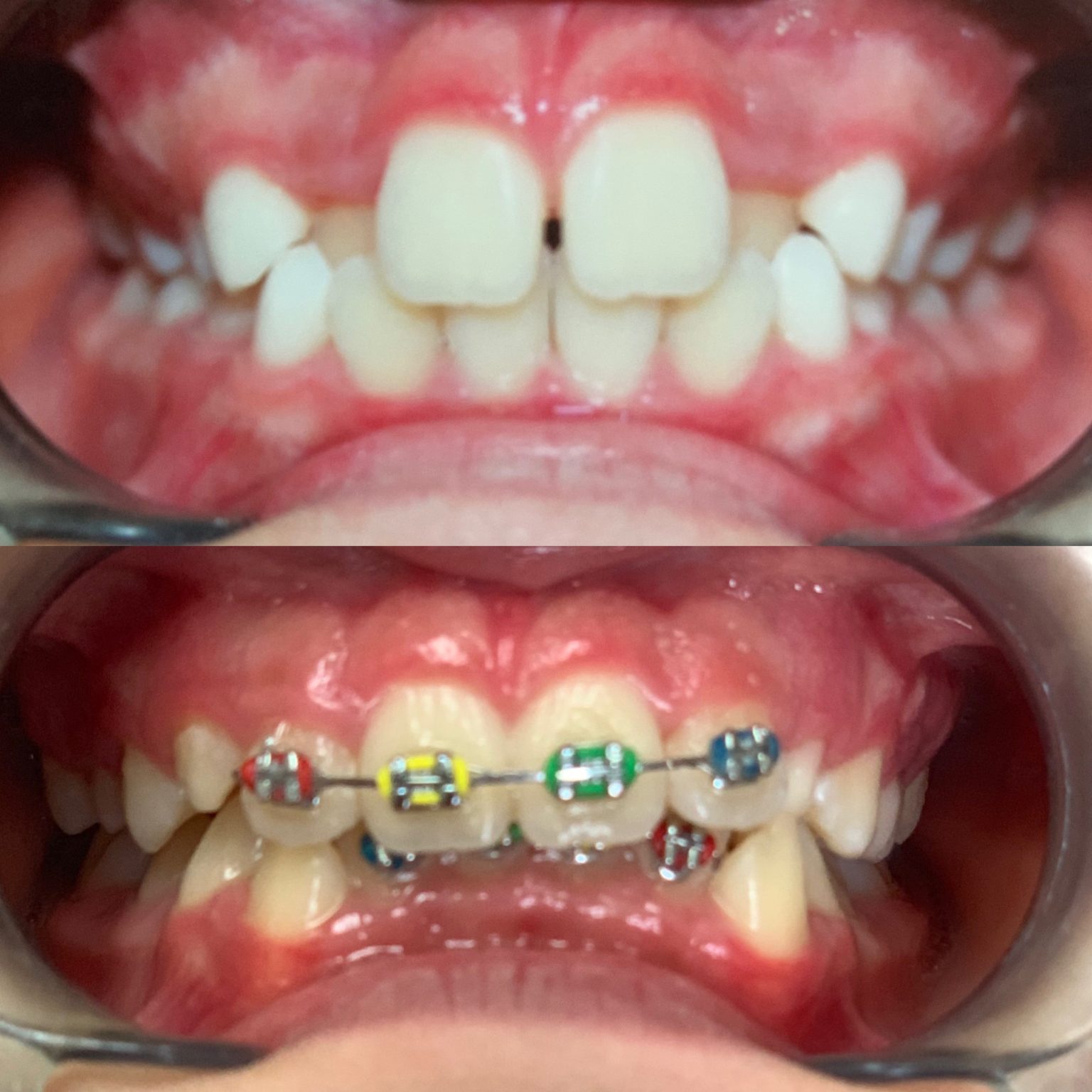 Invisalign Before And After Firouz Orthodontics West Los Angeles