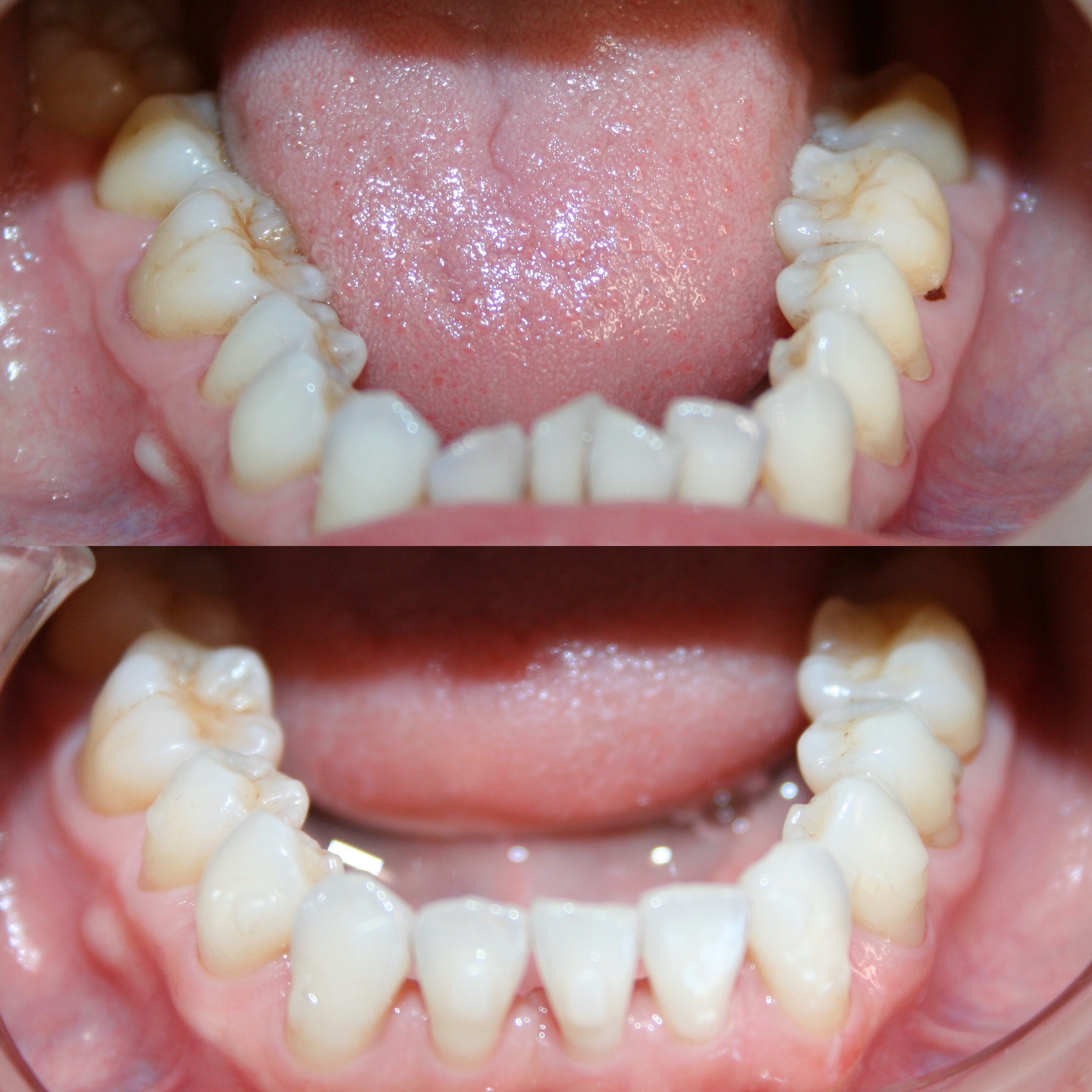 Invisalign Before And After Firouz Orthodontics West Los Angeles