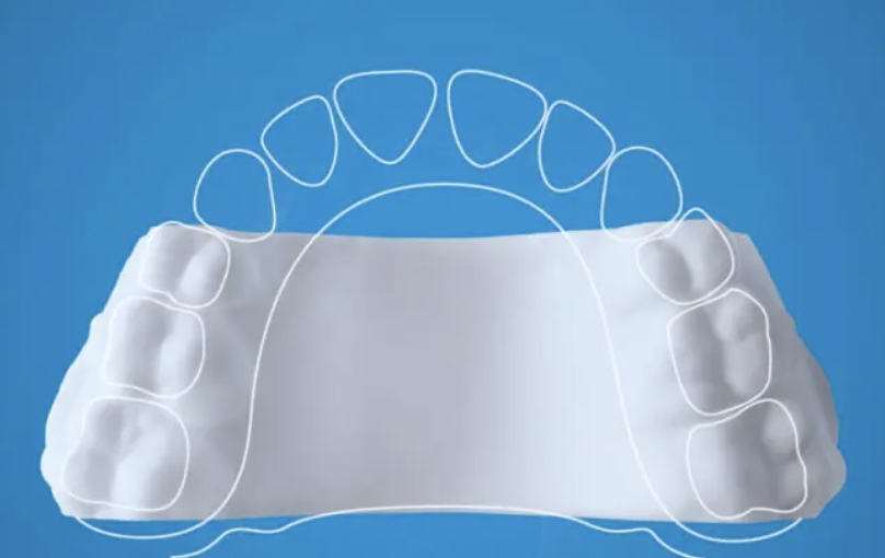 Invisalign Palatal Expander